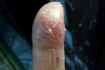 Bong da ngón tay sau sinh là bệnh gì?