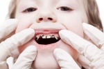 Cha mẹ cần làm gì khi răng của trẻ bị sâu?