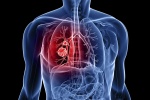 Thuốc mới trị bệnh Ung thư phổi hiếm gặp 