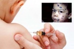 Con tôi đã tiêm vaccine sao vẫn bị thủy đậu?