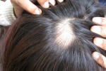 Nghiện nhổ tóc có thể là dấu hiệu của bệnh tâm thần