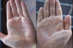 Tróc da bàn tay có phải do thiếu vitamin C?