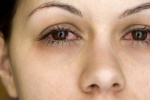 5 mẹo đơn giản chữa đau mắt đỏ ngay tại nhà