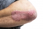 Lupus ban đỏ dạng đĩa: Thể lupus chỉ ảnh hưởng đến da