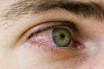 Mắt xuất hiện nhiều gân màu đỏ là bệnh gì?