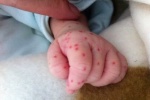 Cảnh báo căn bệnh nguy hiểm thường nhầm với sốt phát ban ở trẻ