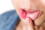 Loét miệng có phải do thiếu vi chất?