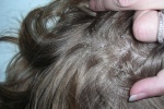 Phương pháp điều trị tự nhiên cho nấm da đầu