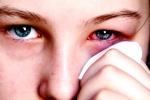 4 bệnh về mắt  dễ bị nhầm với đau mắt đỏ
