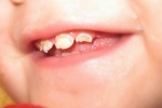 Các vấn đề về răng miệng của trẻ cha mẹ cần biết
