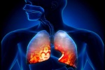 5 cách giúp ngăn ngừa bệnh viêm phổi