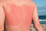 Những loại dược phẩm gây hại cho da trong những ngày nắng nóng