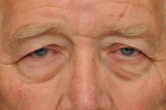 Sụp mi mắt ở người già không trị dễ mù lòa