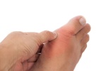 Nhận biết các dấu hiệu của bệnh gout
