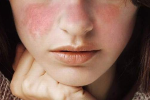 7 dấu hiệu của bệnh lupus mà phụ nữ nên biết
