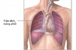 Tràn dịch màng phổi lần 2 có chữa dứt điểm được không?