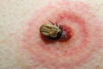 27 nghìn người mắc bệnh Lyme vì bọ ve 