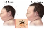 Thái Lan công bố 2 trẻ sinh ra bị đầu nhỏ do virus Zika