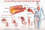 Xơ vữa động mạch vành được hình thành thế nào?