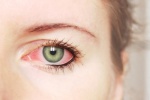 Hà Nội: Lại tái xuất nguy cơ cả nhà đau mắt đỏ