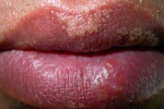 Mọc mụn trắng li ti ở môi là bệnh gì?