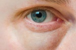 Mắt sưng sau 24h không khỏi là dấu hiệu bệnh nguy hiểm