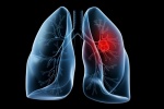 Liệu bạn có thực sự hiểu rõ về bệnh ung thư phổi?