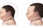 Những thủ phạm gây dị tật đầu nhỏ ở thai nhi: Làm sao phát hiện và dự phòng?