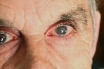 2 mắt bị đục thủy tinh thể có nên phẫu thuật cả 2 cùng 1 lúc? 