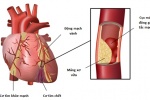Cholesterol - Thủ phạm gây xơ vữa động mạch
