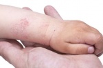 10 biện pháp tại nhà giúp bạn đối phó với bệnh eczema