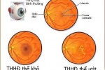 5 cách để bảo vệ đôi mắt khỏi thoái hóa điểm vàng