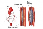 Chăm sóc bệnh nhân đặt stent mạch vành thế nào?