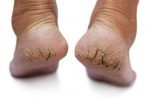 Cách chữa nứt gót chân siêu đơn giản mà bạn chưa biết