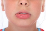Hội chứng dị ứng đường miệng là gì?