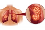 7 triệu chứng của bệnh ung thư phổi ai cũng nên biết