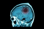 7 dấu hiệu cảnh báo bạn có 1 khối u trong não