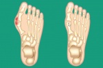 8 cách giảm đau hiệu quả cho người bị biến dạng ngón chân cái