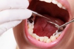 Những cách đơn giản để bảo vệ răng và nướu