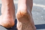 5 nguyên nhân gây bong tróc da chân trong mùa Hè