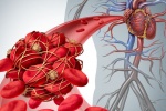 Mối liên hệ giữa cục máu đông và vi khuẩn đường ruột