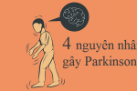 4 nguyên nhân có thể gây ra bệnh Parkinson