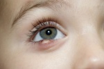 5 biện pháp tự nhiên giúp khắc phục mắt bị lẹo