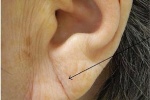 Vết lằn chéo ở dái tai, dấu hiệu cảnh báo nguy cơ cao dẫn tới đột quỵ