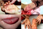 TP.HCM: Hơn 100 ca mắc bệnh tay chân miệng chỉ trong 1 tuần