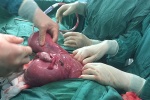 Người phụ nữ phải cắt toàn bộ tử cung vì mang khối u “khủng” nặng 8 kg