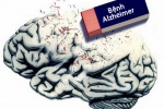 Bệnh Alzheimer gây ra ảnh hưởng gì tới não bộ?