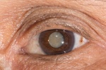 Chăm sóc mắt trước và sau phẫu thuật đục thủy tinh thể thế nào?