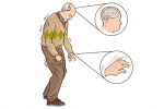 Nhận biết 9 dấu hiệu cảnh báo bệnh Parkinson