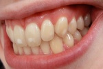 10 cách tự nhiên loại bỏ đốm trắng xấu xí trên răng
